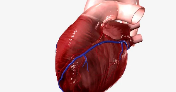 アテローム性動脈硬化性プラークが一定の大きさに達すると 動脈を完全に閉塞させるか プラークの一部が破裂して塊を形成し 閉塞を引き起こす可能性があります 3Dレンダリング — ストック写真