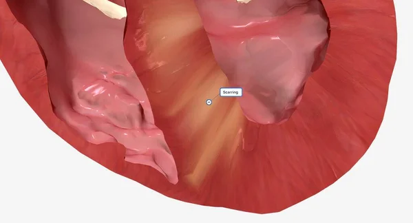 Miocardiopatía Hipertrófica Ocurre Cuando Las Células Musculares Del Corazón Agrandan — Foto de Stock