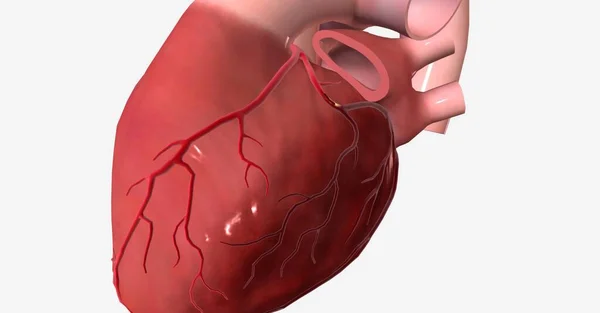 Enfarte Miocárdio Ataque Cardíaco Uma Doença Grave Que Ocorre Quando — Fotografia de Stock