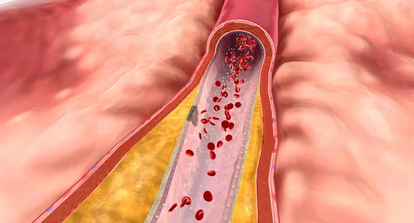 高脂質血症では 過剰脂質は動脈壁に蓄積し プラークと呼ばれる脂肪質物質を形成することができます 3Dレンダリング — ストック写真