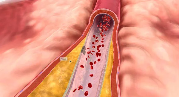 高脂質血症では 過剰脂質は動脈壁に蓄積し プラークと呼ばれる脂肪質物質を形成することができます 3Dレンダリング — ストック写真