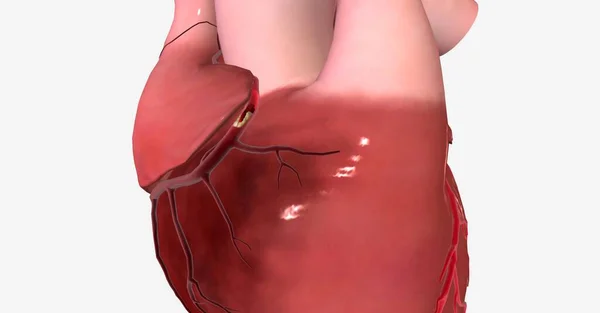 Myocardinfarct Hartaanval Een Ernstige Aandoening Die Optreedt Wanneer Bloed Zuurstoftoevoer — Stockfoto