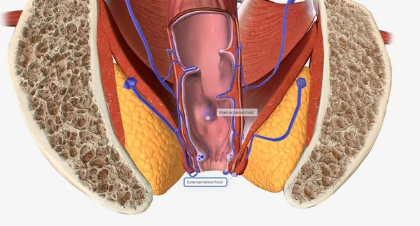 痔疮是一种常见的疾病 其特点是肛门或直肠下部的血管肿胀 3D渲染 — 图库照片