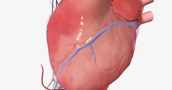Niedokrwienie Mięśnia Sercowego Jest Spowodowane Zmniejszonym Przepływem Krwi Serca Brakiem — Zdjęcie stockowe