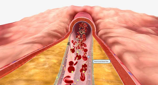 지방혈증 지남에 플라크가 동맥을 혈액의 흐름을 수있다 — 스톡 사진