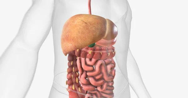Bezalkoholowa Choroba Wątroby Tłuszczowej Nafld Jest Stanem Którym Nadmiar Komórek — Zdjęcie stockowe
