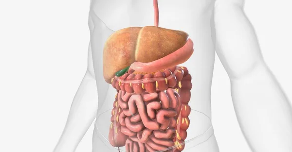 Penyakit Hati Gendut Non Alkohol Bahasa Inggris Fatty Liver Disease — Stok Foto
