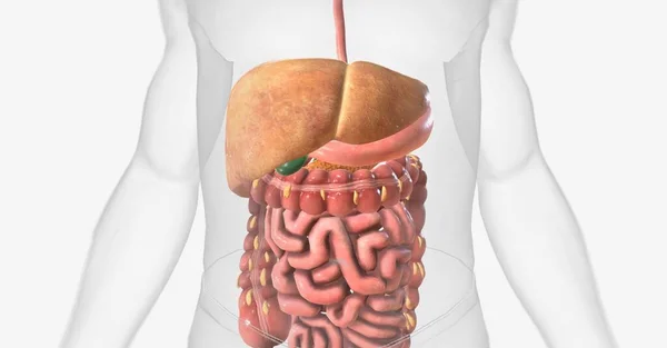 非酒精性脂肪肝 Nafld 是一种存在于肝脏中的多余脂肪细胞的疾病 3D渲染 — 图库照片