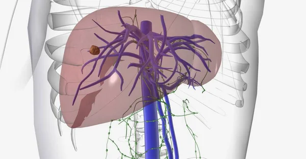 从肝脏开始最常见的癌症是肝细胞癌 Hcc 3D渲染 — 图库照片
