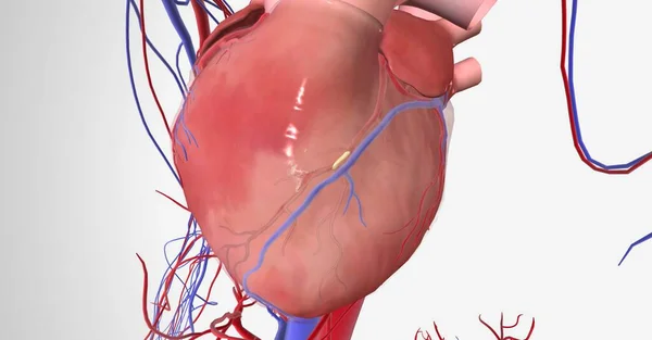 Isquemia Miocárdica Causada Por Reducción Del Flujo Sanguíneo Corazón Falta — Foto de Stock