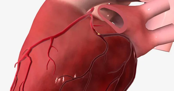 Hjärtinfarkt Hjärtinfarkt Ett Allvarligt Tillstånd Som Uppstår När Blod Och — Stockfoto