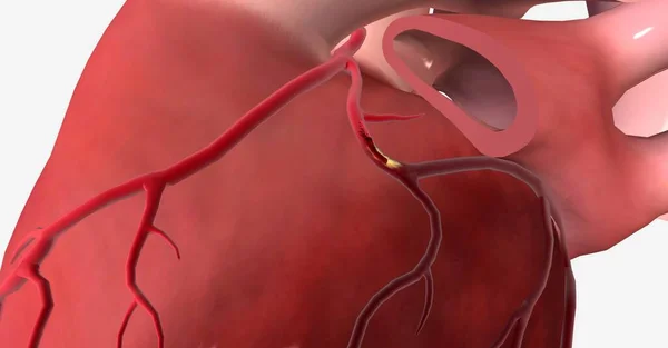 心筋梗塞 心臓発作 心臓への血液や酸素の供給が減少し 心臓の筋肉の一部が突然死ぬことが起こる深刻な状態です 3Dレンダリング — ストック写真