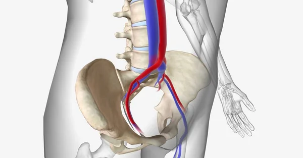 Síndrome May Thurner Compresión Vena Ilíaca Común Izquierda Entre Arteria Imagen De Stock