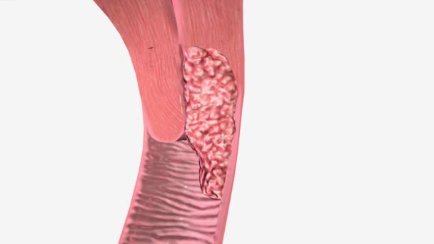 Tahap Berarti Kanker Telah Menyebar Luar Leher Rahim Dalam Jaringan — Stok Video