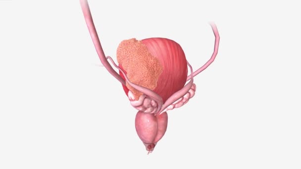 膀胱がんの病期Iiiがんは2つ以上の局所リンパ節または一般的なイリアックリンパ節に転移している — ストック動画