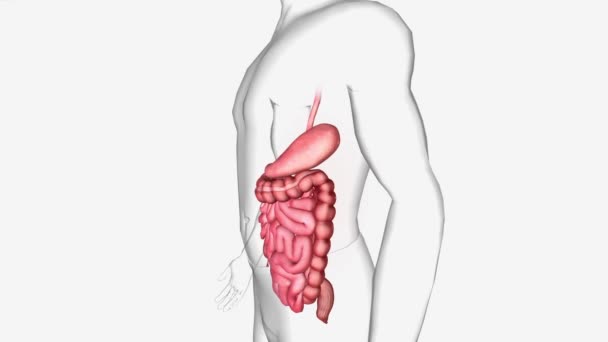Gastroenterite Viral Uma Infecção Intestinal Que Inclui Sinais Sintomas Como — Vídeo de Stock