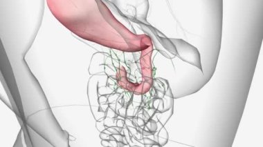 Duodenal Karsinom 3. aşama. İnce bağırsağın diğer bölgeleri kanser hücrelerinden etkileniyor.