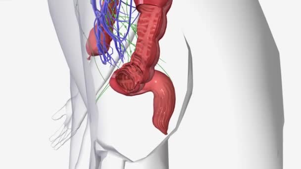 I期結腸がんは結腸壁の層により深く成長しました — ストック動画