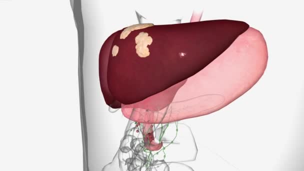 十二指腸がんステージ4がんは 肝臓全体を含む身体の他の領域にも広がっています — ストック動画