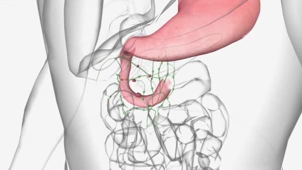 Duodenal Carcinoma Stage Adjoining Organs Other Areas Small Intestine Now — Stock Video