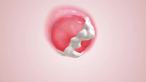 子宮頸部は子宮の端の腫脹または炎症を起こした組織である Cervix — ストック動画