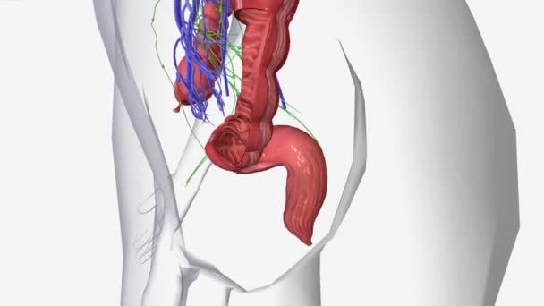 病期Iiがんは結腸または直腸壁に転移しているが リンパ節に転移していない — ストック動画