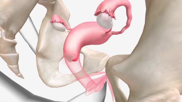 骨盤炎症性疾患は 女性の生殖器の感染症です — ストック動画