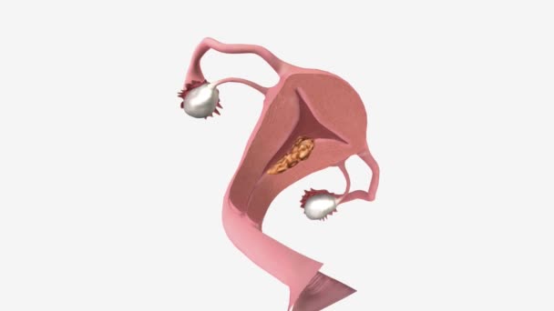 Cáncer Endometrio Estadio Mostrado Dibujo Transversal Del Útero Cuello Uterino — Vídeo de stock