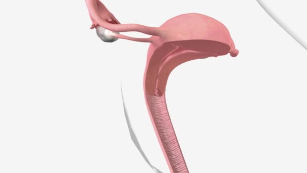 ステージ1は 癌が子宮の首にのみあることを意味します Cervix — ストック動画