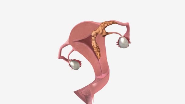 Stage Iiib Endometrial Cancer Cancer Has Spread Vagina Parametrium Connective — Stock Video
