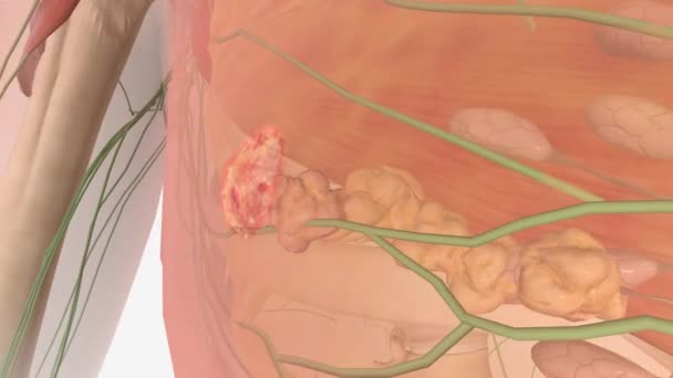ステージIiiの腫瘍は胸の奥深くに広がり — ストック動画