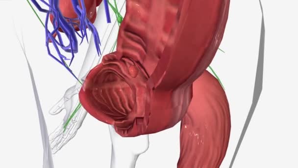 大腸がんステージ0 — ストック動画