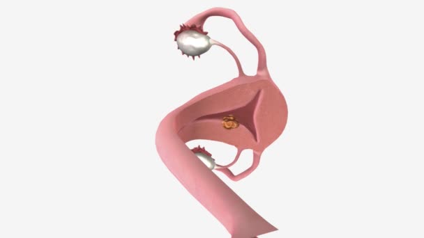 Stadium Cancer Endometriet Endast Eller Mindre Halvvägs Genom Myometriet Muskellagret — Stockvideo