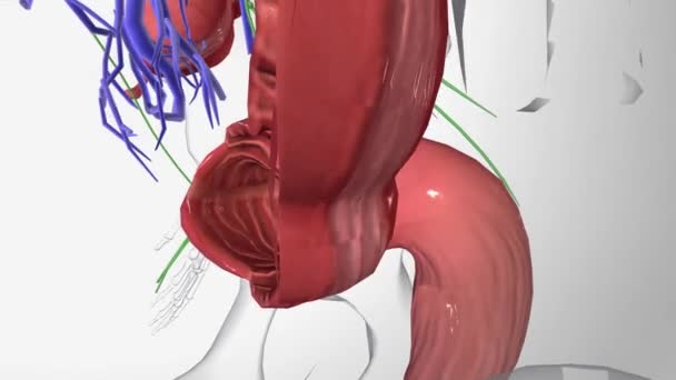 大腸がんステージ0 — ストック動画
