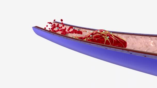 Тромб в глубокой вене ноги, таза, а иногда и руки, называется тромбозом глубоких вен.