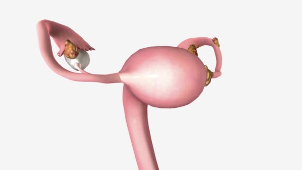 Cáncer Ovario Estadio Significa Que Cáncer Crecido Fuera Los Ovarios — Vídeo de stock