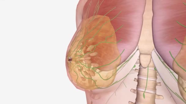 Brustkrebs Stadium Bedeutet Dass Der Krebs Klein Und Nur Brustgewebe — Stockvideo