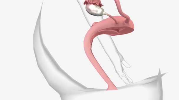 ステージ3子宮頸がんとは 子宮頸がんが子宮頸部から周囲の組織に転移したことを意味します — ストック動画