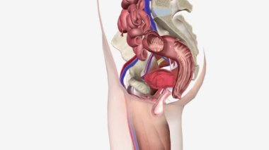 3d Vajinal Kasa Prolapse 4