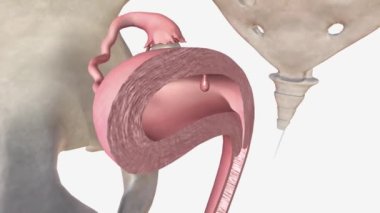Endometrium polip ya da rahim polipsi, rahim boşluğunu dolduracak kadar küçük ya da büyük boşlukları kaplayan, rahmin astarından yansıyan bezler, stroma ve kan damarları içeren anormal bir büyümedir..