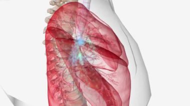 COVID-19 akciğerin şiddetli belirtileri