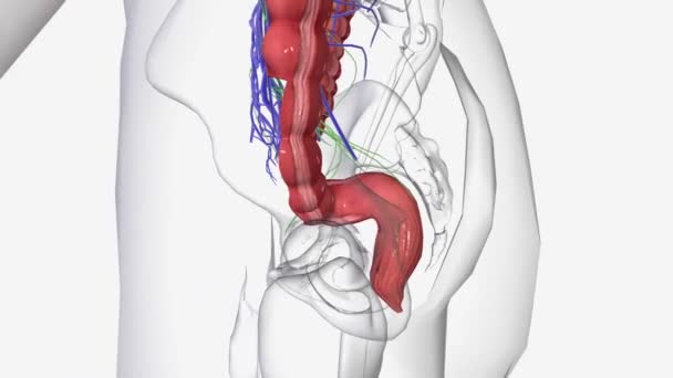 ステージIiiの結腸がんは近くのリンパ節に転移しているが まだ他の部位に転移していない — ストック動画