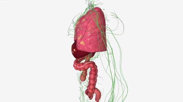 ステージ4肝臓に転移する大腸がんです — ストック動画