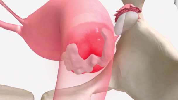 Malattia Infiammatoria Pelvica Infezione Degli Organi Riproduttivi Una Donna — Video Stock
