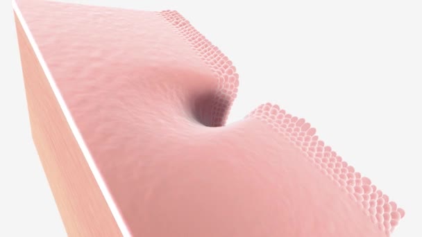 Endometriyumun Üst Katmanında Kanser Hücreleri Varsa Endometriyal Kanser Safhası Olarak — Stok video
