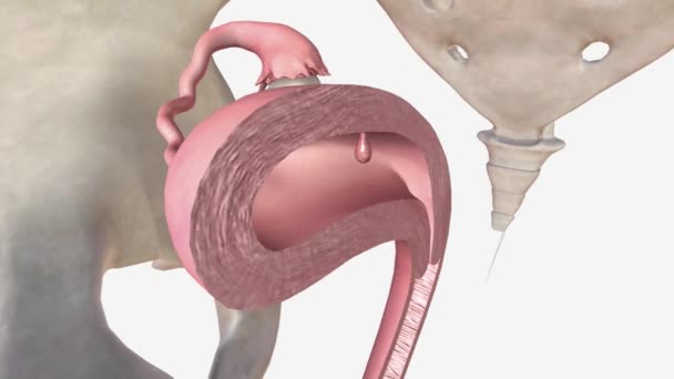 Pólipo Endometrial Pólipo Uterino Crecimiento Anormal Que Contiene Glándulas Estroma — Vídeo de stock