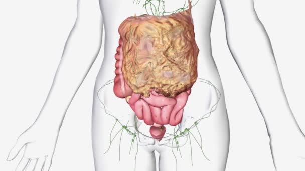 Tahap Kanker Ovarium Telah Menyebar Luar Panggul Dalam Rongga Perut — Stok Video