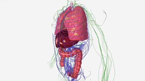 ステージ4結腸がんは最も重大で進行した病期です それは癌が体の他の部分に結腸の外に広がっていることを意味します — ストック動画