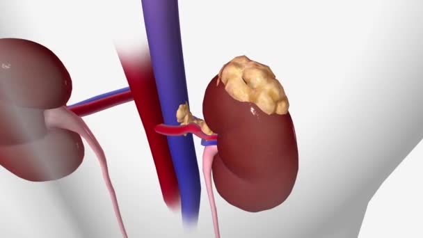 ステージIv腎臓癌 腎臓の周りに脂肪組織の層を超えて広がり癌と腎臓の上の副腎にまで広がるかもしれません — ストック動画