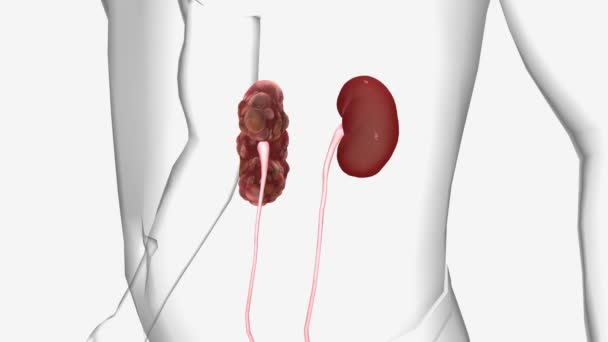多嚢胞性腎臓病とは 腎臓が成長して機能を失う病気です — ストック動画